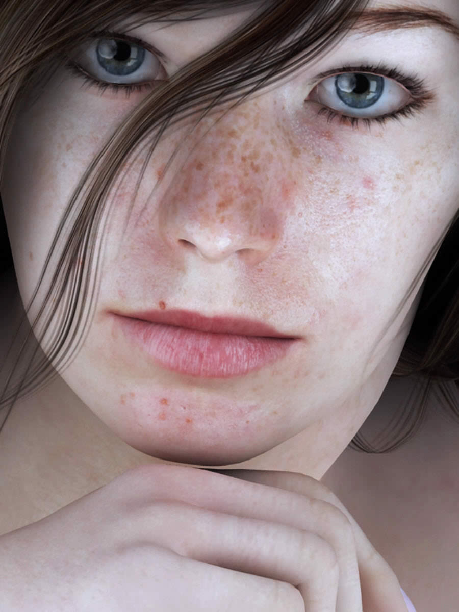 Freckle Test