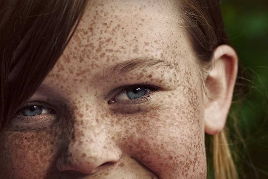 Freckles 1