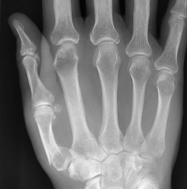 Hand - Thumb Fracture