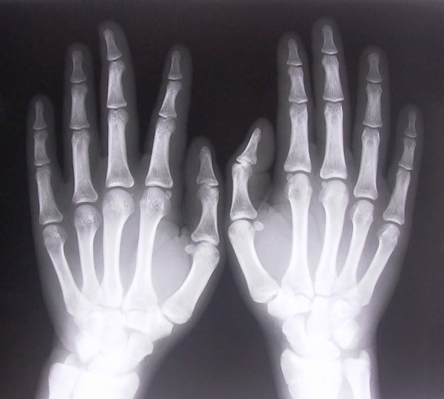 X-Ray Hands