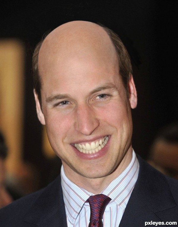 Hair Plugs, Wills!