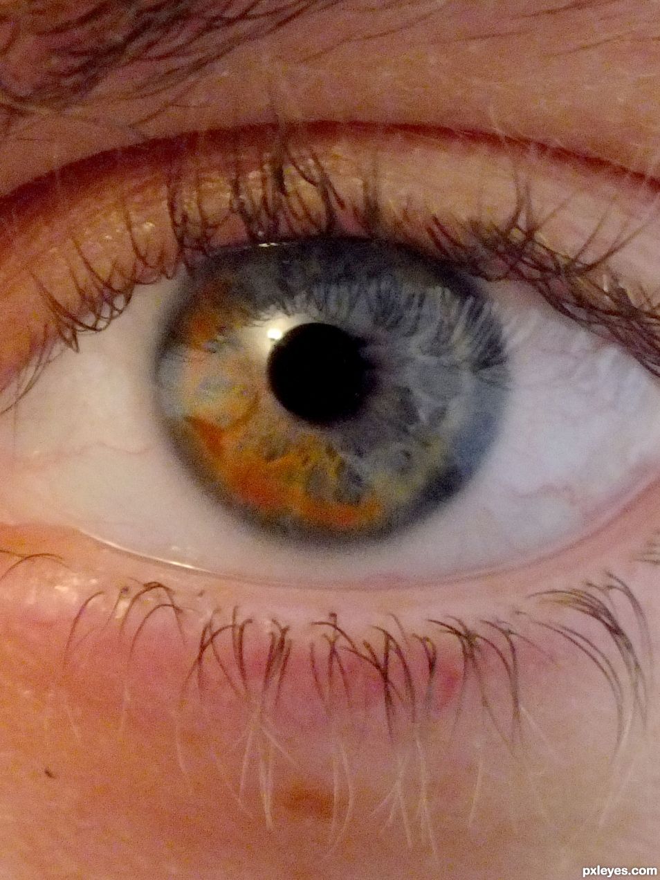 Heterochromia iridum