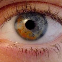 Heterochromiairidum