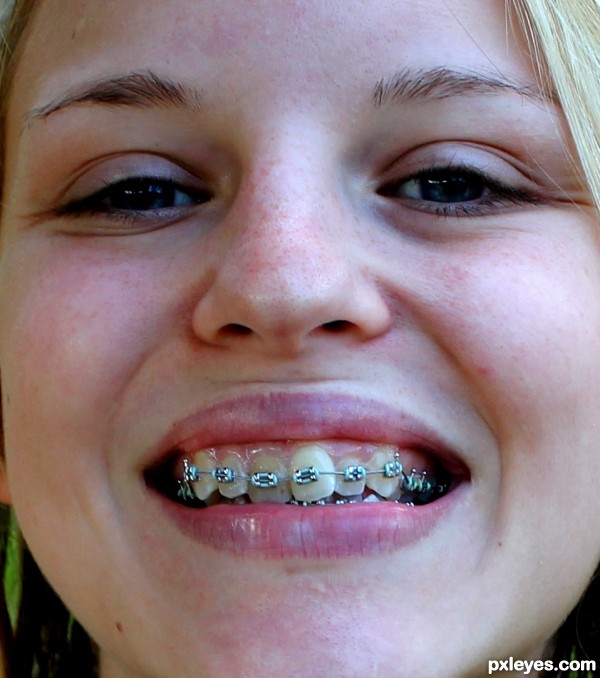 Braces