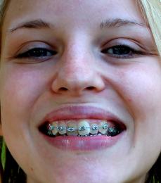 Braces