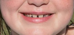 Young smile