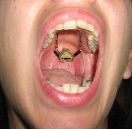 Frog in Your Throat