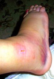 Sprained ankle
