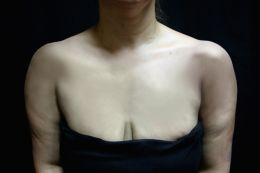 Breast